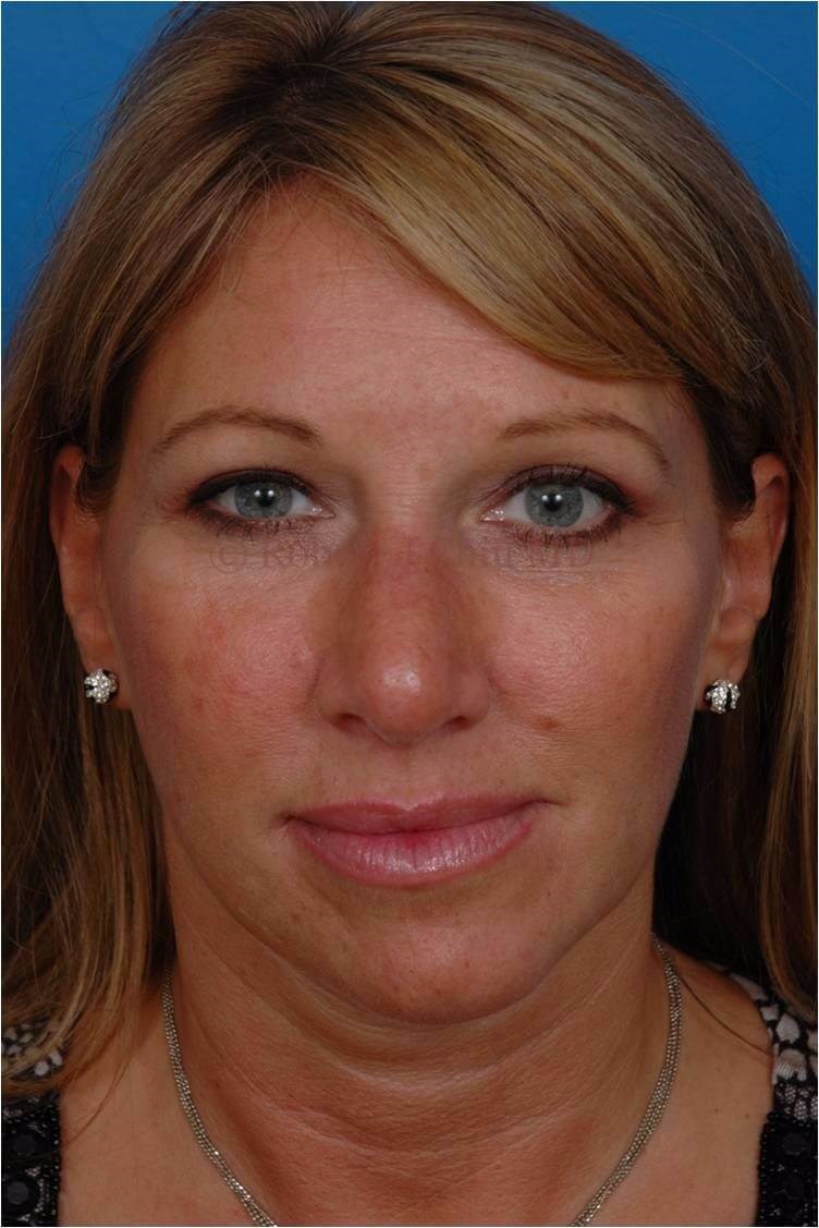 Front View After Front View After