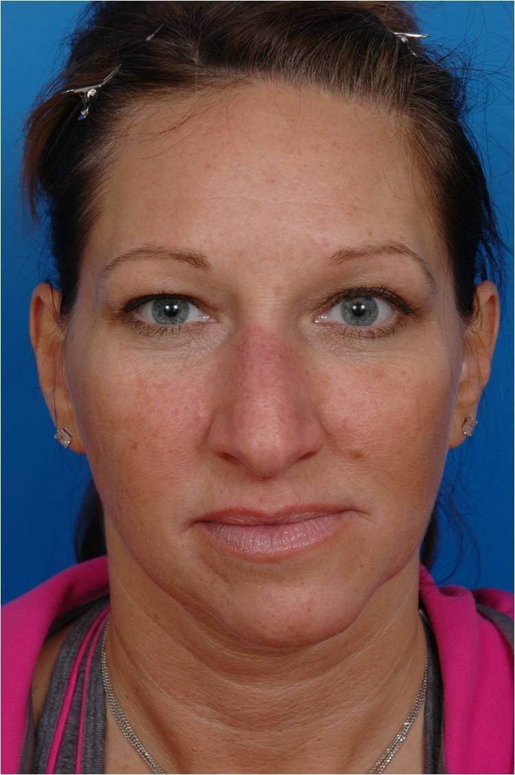 Front View Before Front View Before