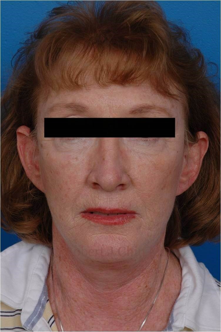 Front View Facelift/Necklift After