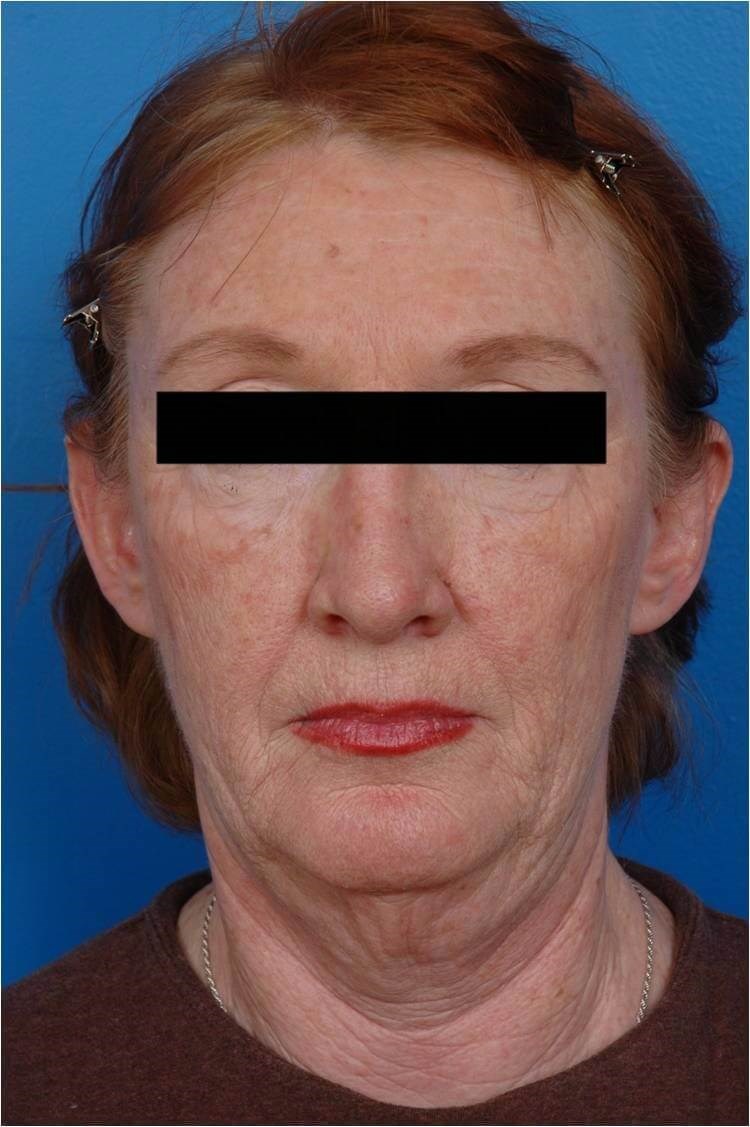 Front View Facelift/Necklift Before