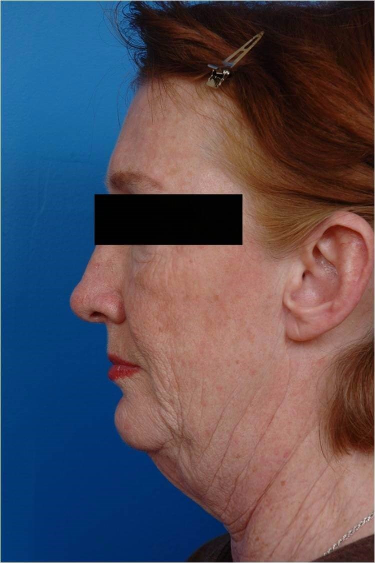 Facelift/Necklift Profile View Before