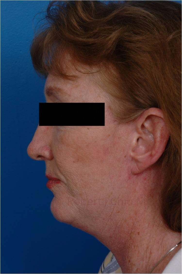 Facelift/Necklift Profile View After