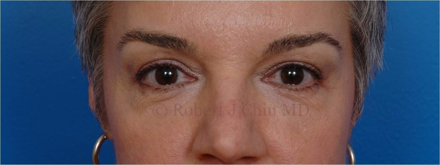 Front View Blepharoplasty After