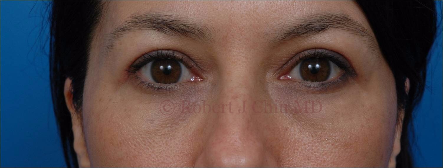 Front View Blepharoplasty After