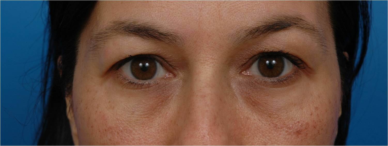 Front View Blepharoplasty Before
