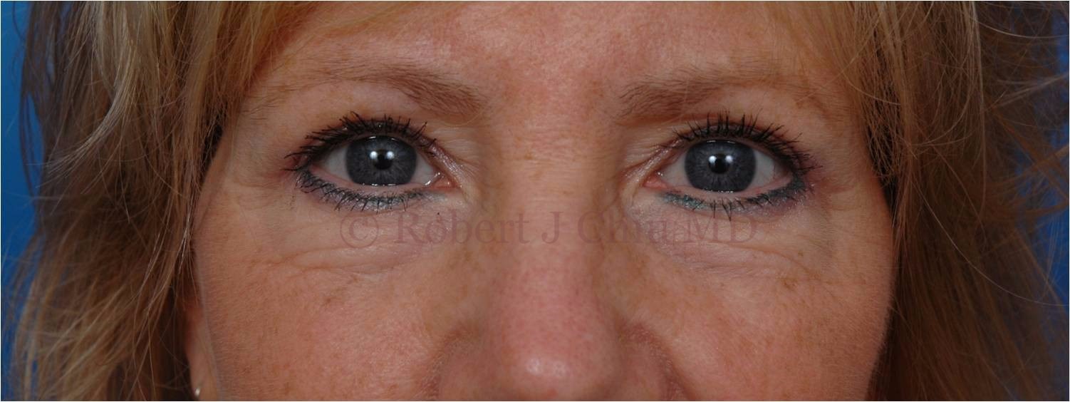 Front View Blepharoplasty After