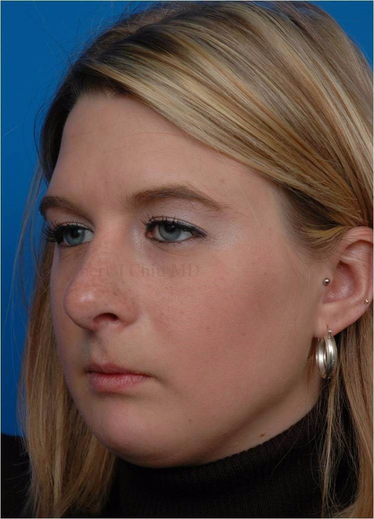 Front View Rhinoplasty After