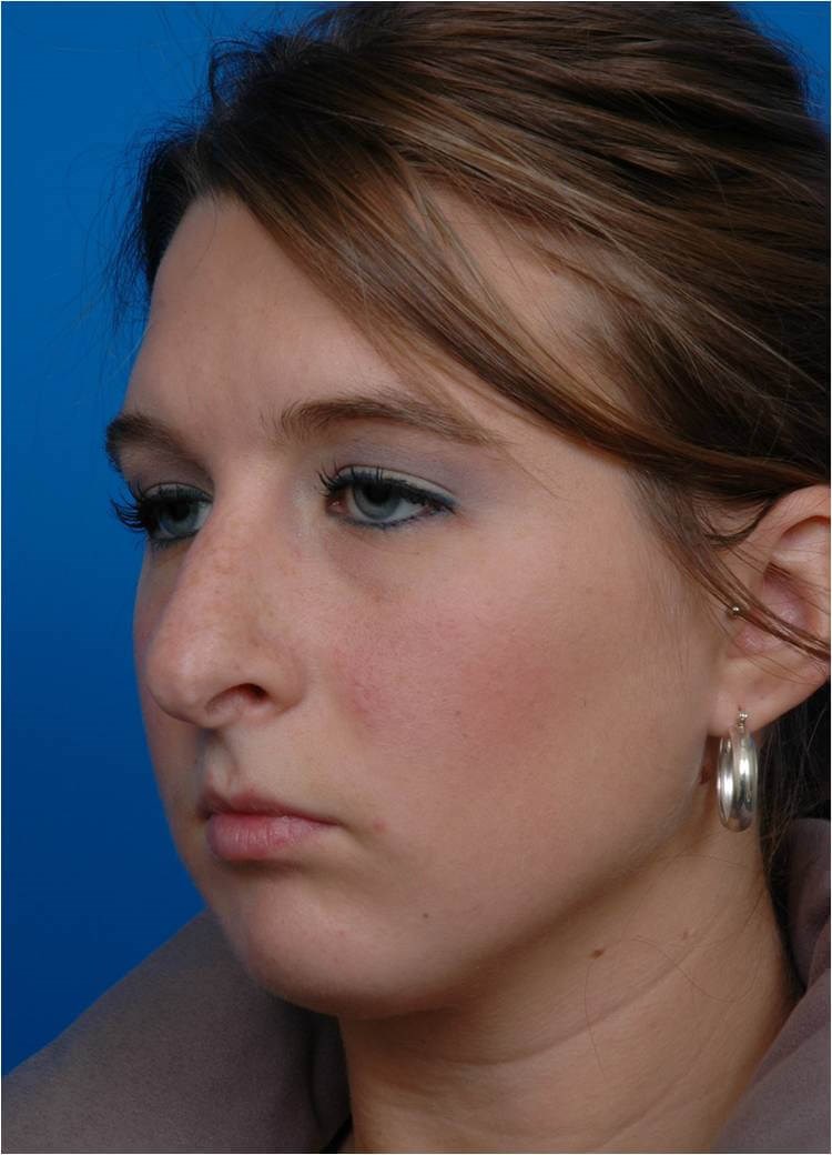 Front View Rhinoplasty Before