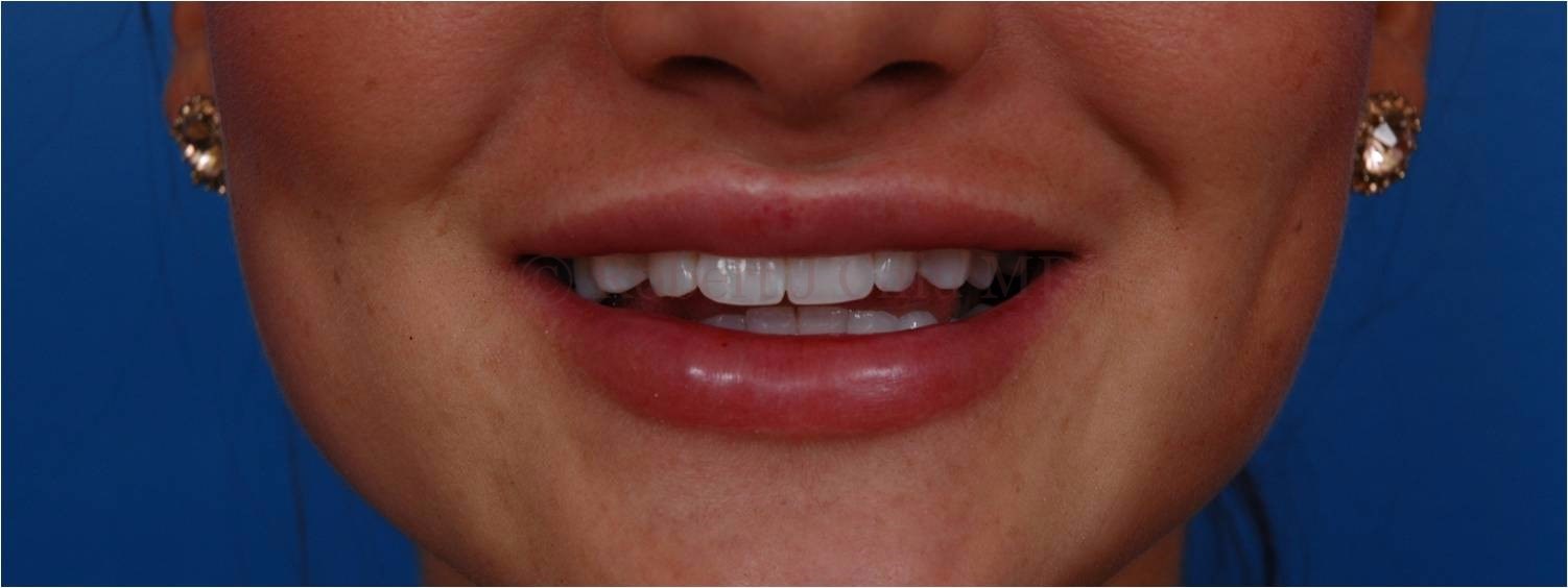 Front View Lip Augmentation After