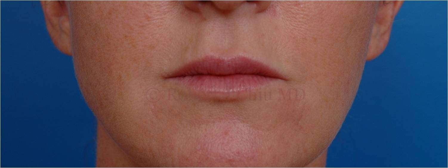Front View Lip Augmentation After