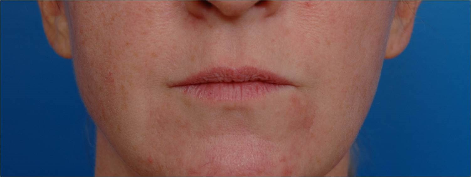 Front View Lip Augmentation Before