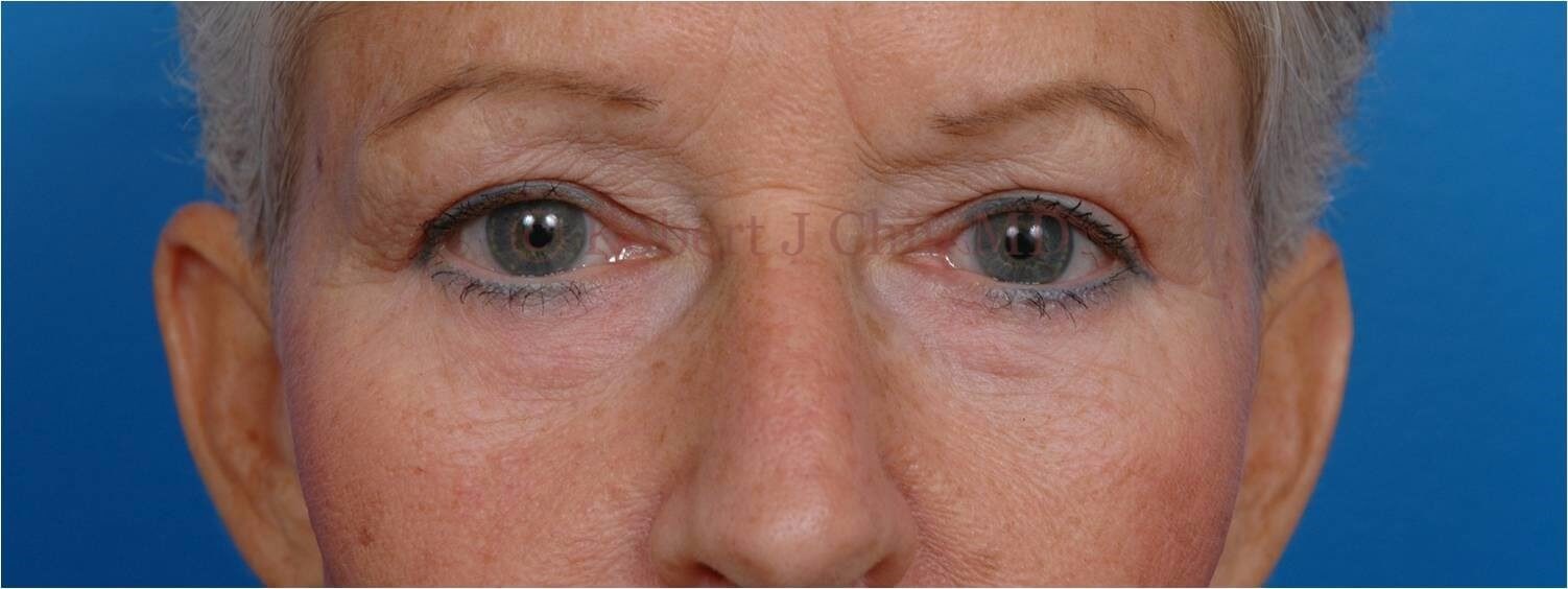 Front View Blepharoplasty After