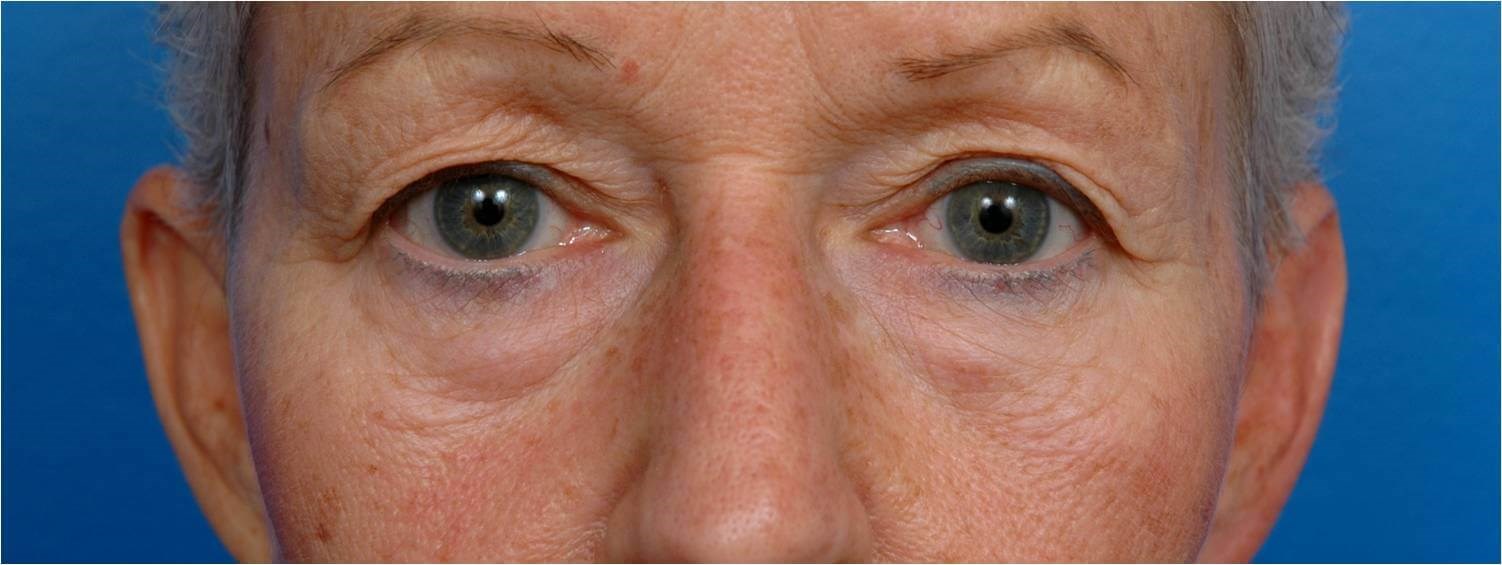 Front View Blepharoplasty Before