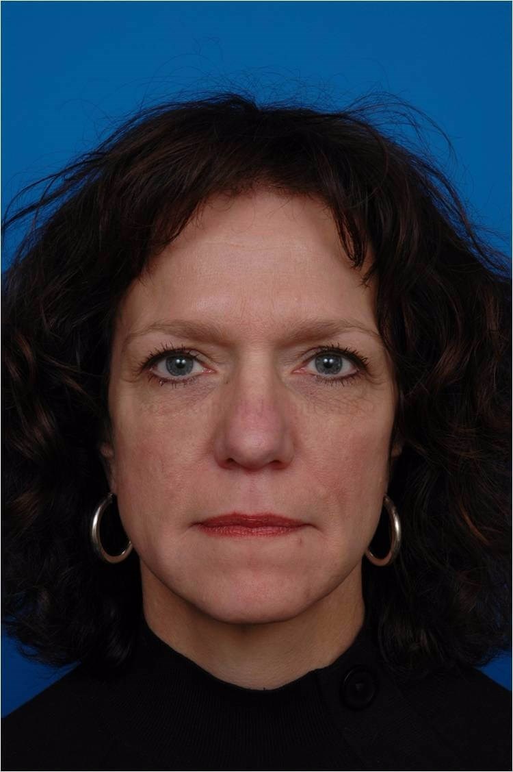 Front View Liquid Facelift After