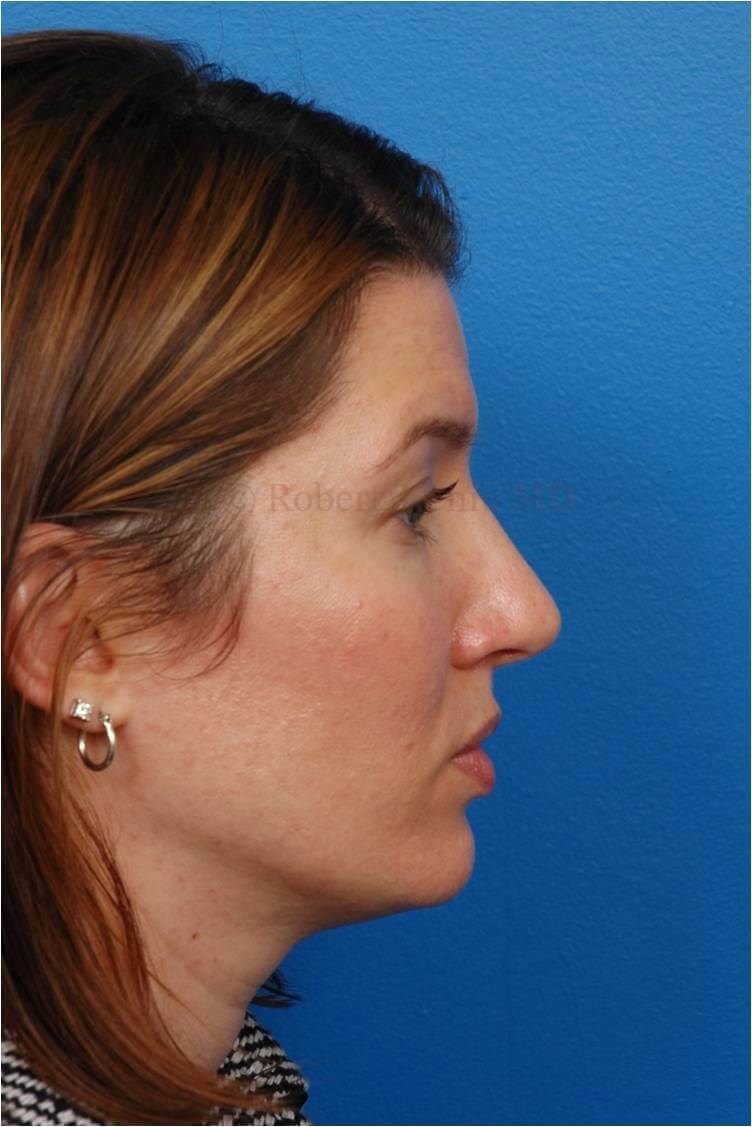 Right Profile View Rhinoplasty After
