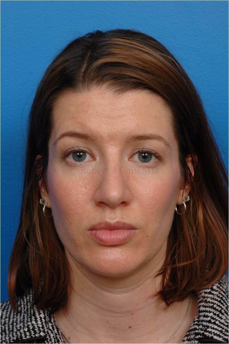 Front View Rhinoplasty After