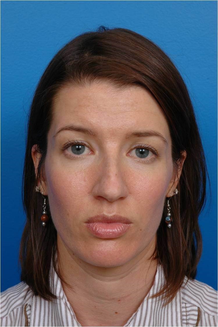 Front View Rhinoplasty Before