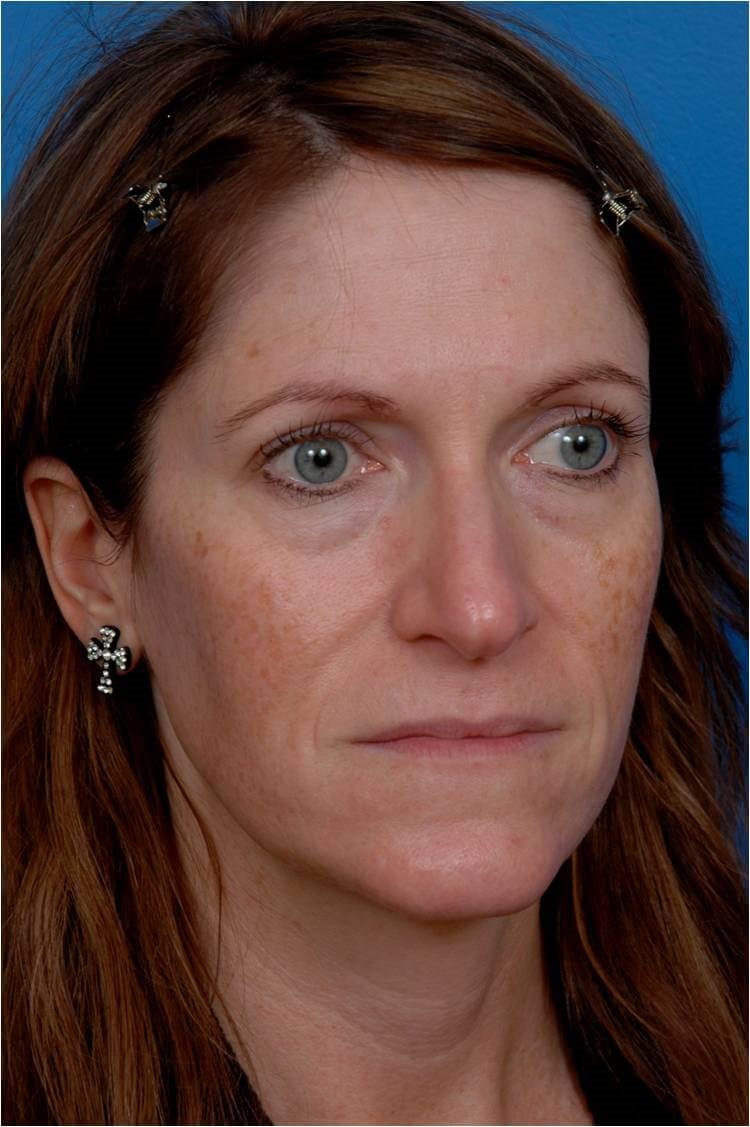 Right 3/4 View Liquid Facelift Before