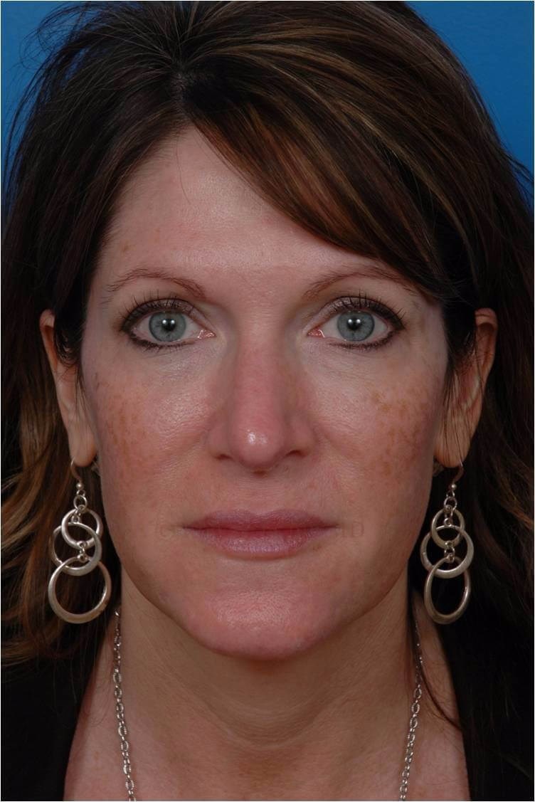 Front View Liquid Facelift After