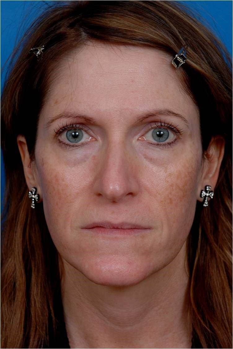 Front View Liquid Facelift Before