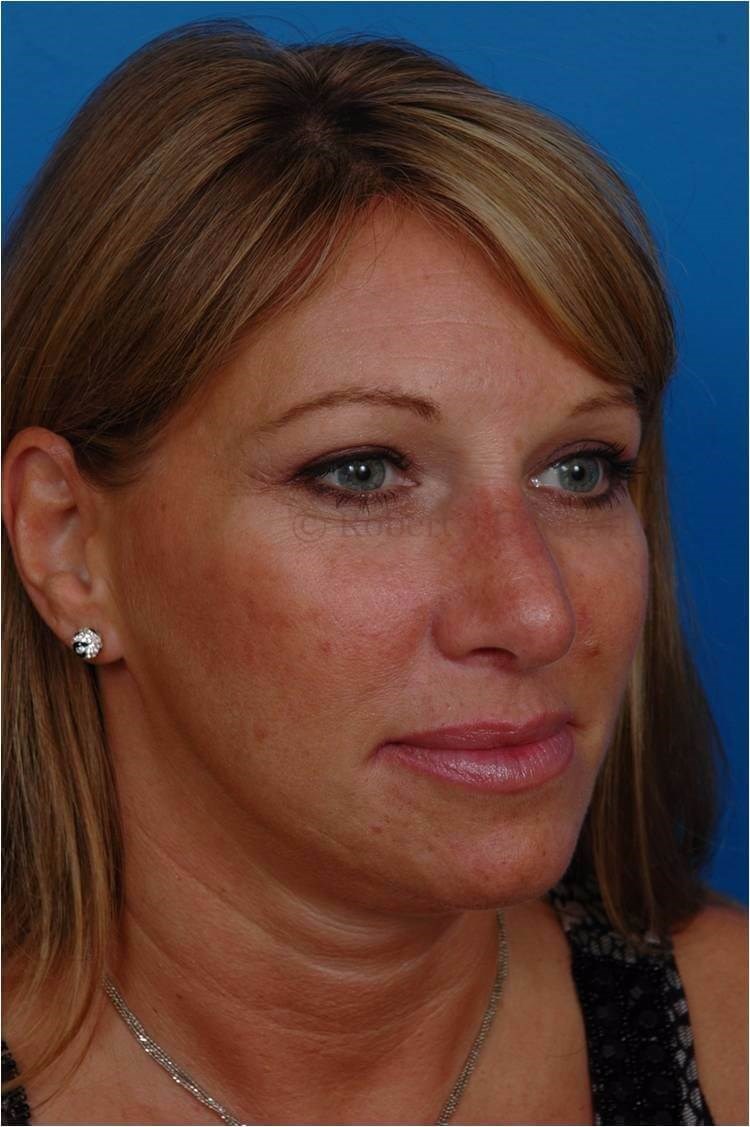 Right 3/4 View After