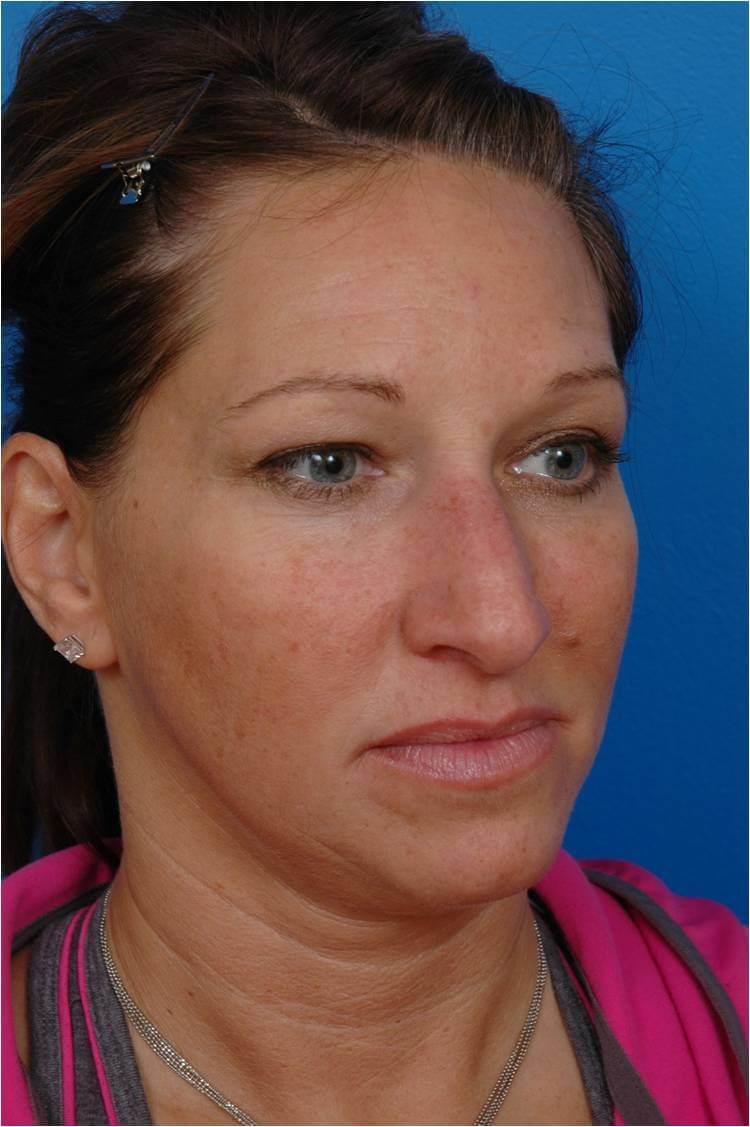 Right 3/4 View Before