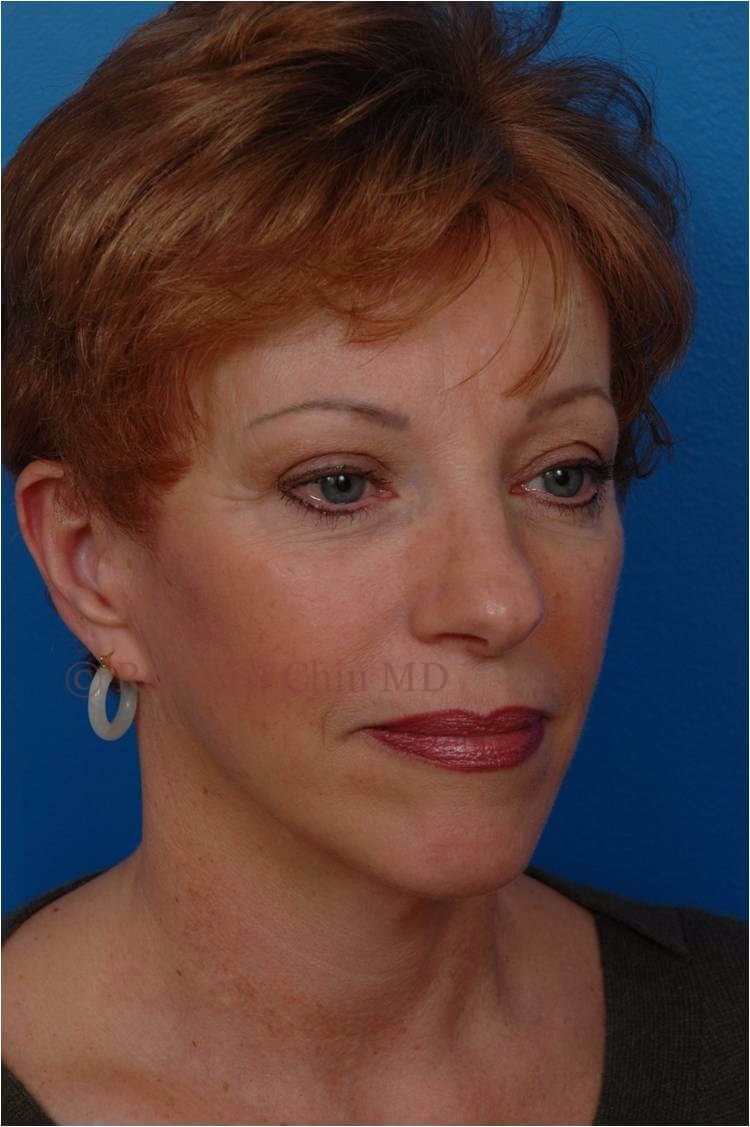 Rt 3/4 View Minilift/Browlift After