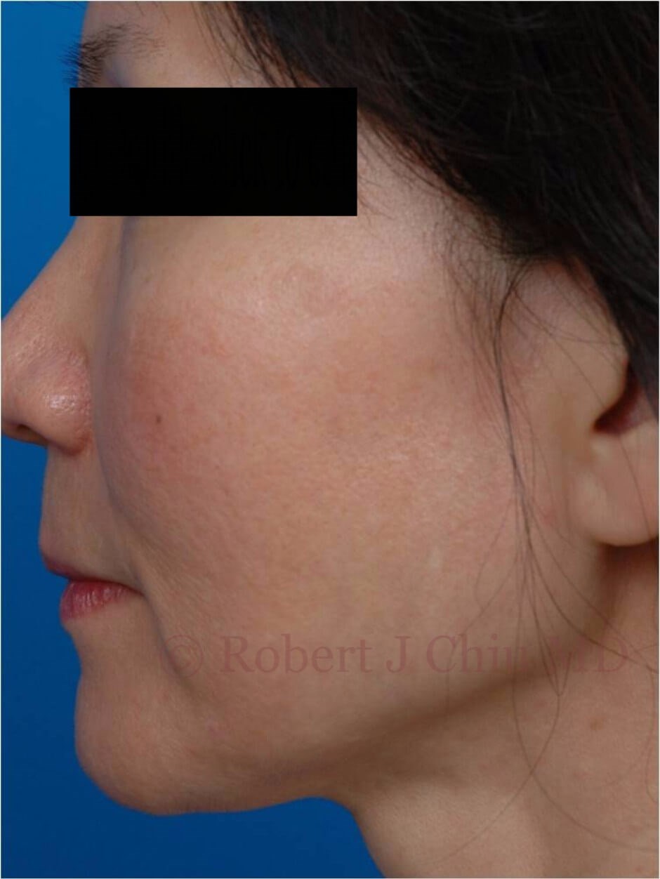 Profile View Fraxel Laser  After