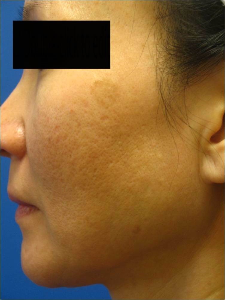 Profile View Fraxel Laser  Before