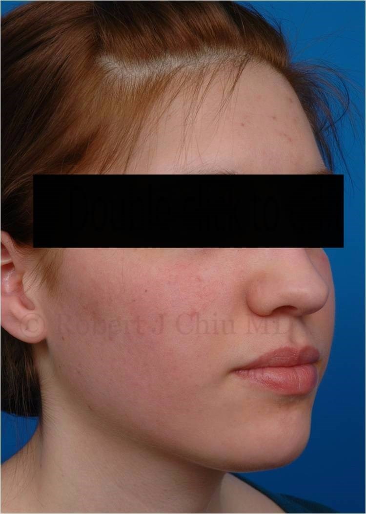 Right 3/4 View Fraxel Laser Tx After