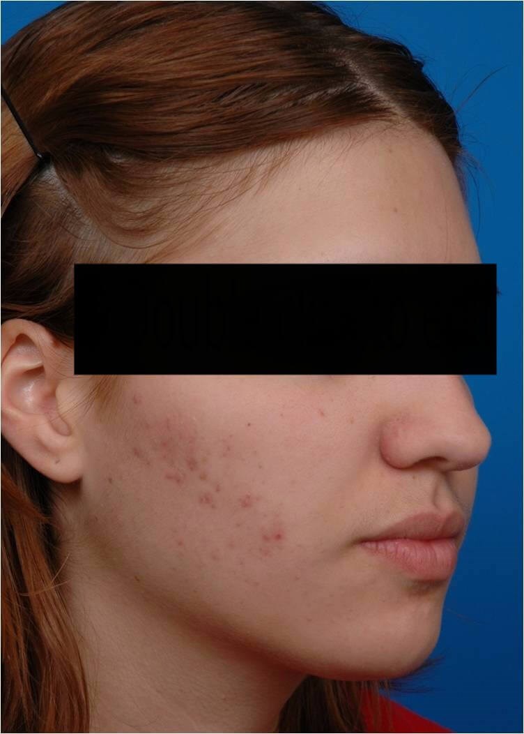 Right 3/4 View Fraxel Laser Tx Before