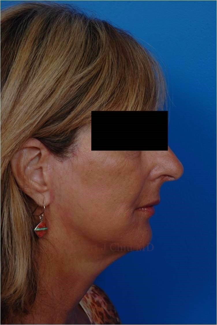 Right Profile View Facelift After