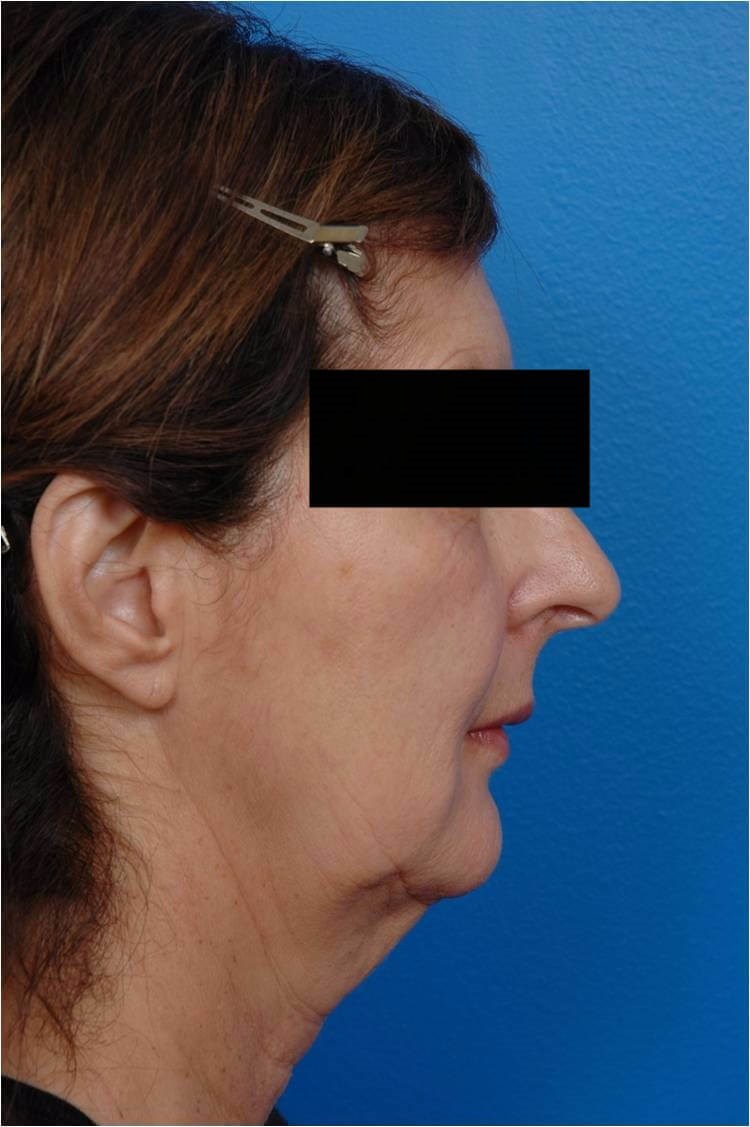 Right Profile View Facelift Before