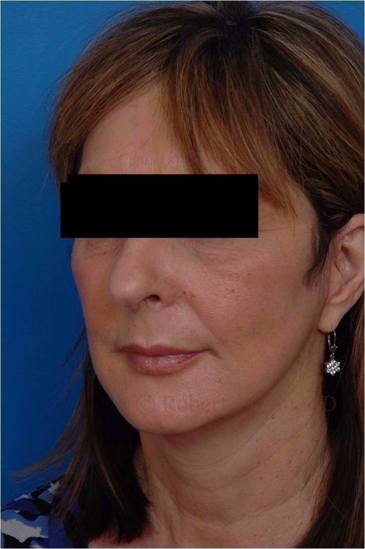 Left 3/4 View Lower Facelift After